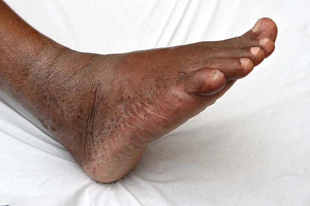 Lépromes pieds