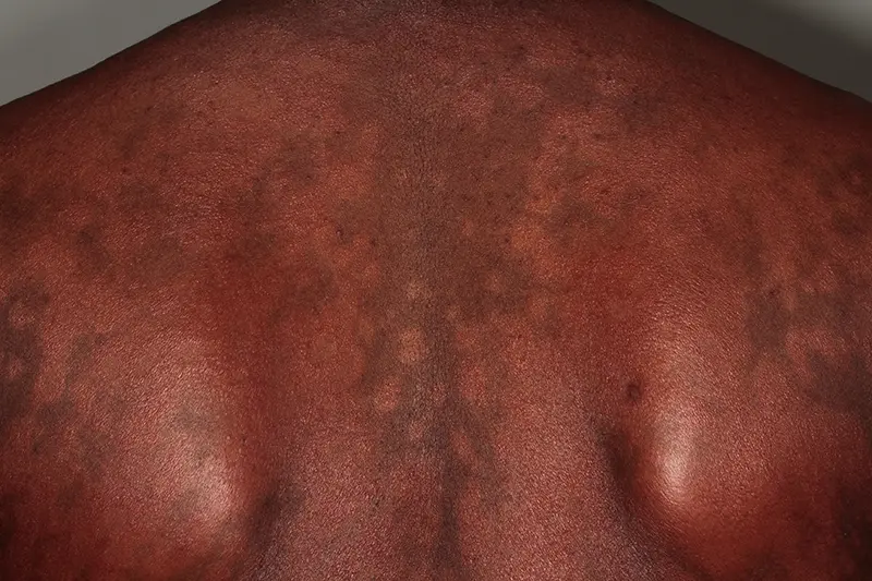 Lèpre lepromateuse : atteinte du dos