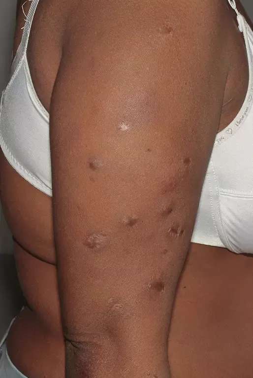 Erythème noueux lépreux du membre supérieur