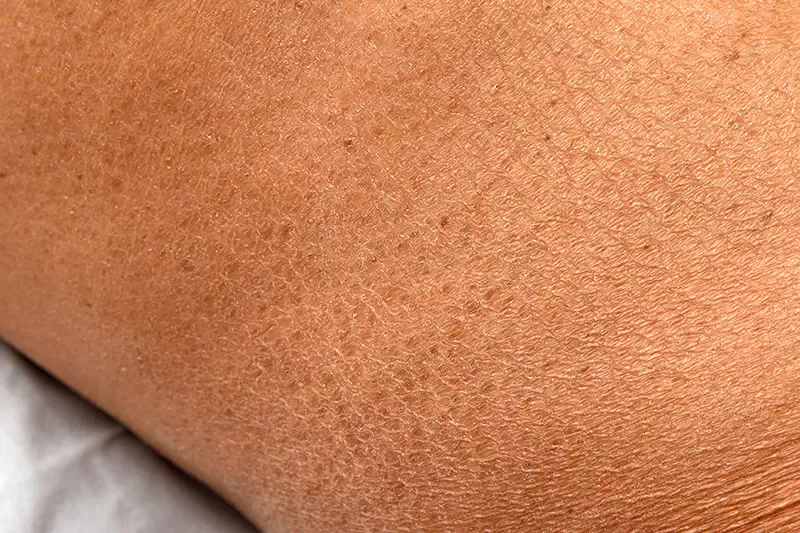 maladie peau dermatologie lépre